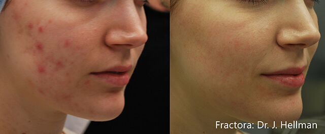 JH_Fractora_3f_4tx_RS_1month_Acne_24pin_30to50mJ_ZP