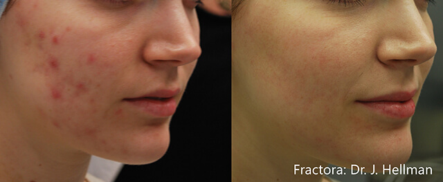 acne littekens verwijderen fractora